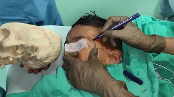 Suprazygomatic approach maxillary nerve block: Our take!