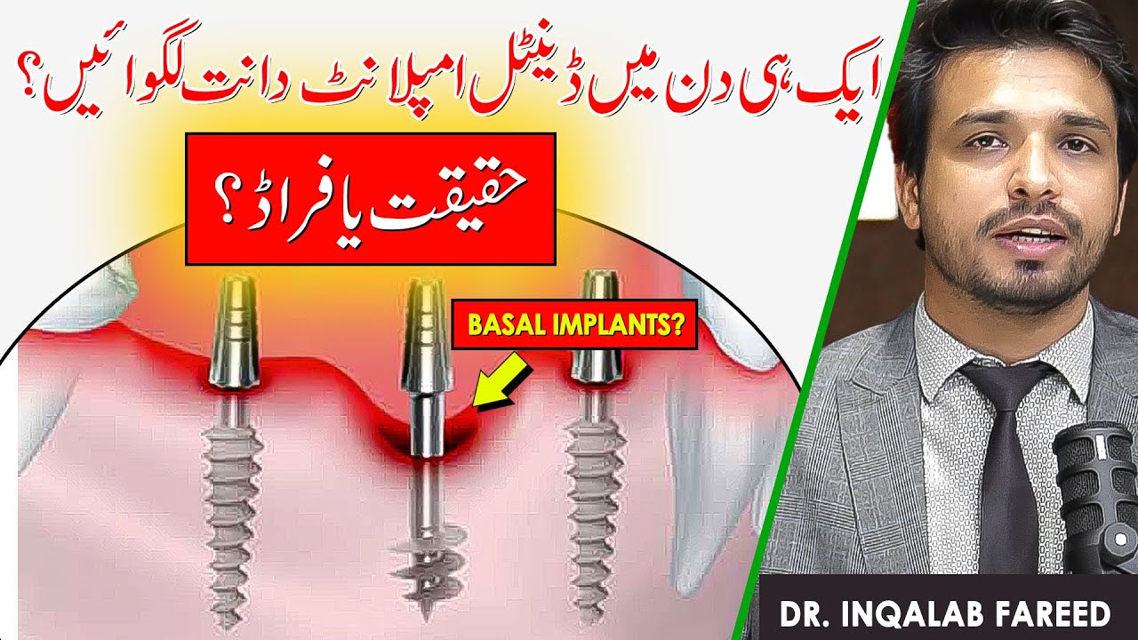 ТЁМНАЯ ПРАВДА о базальных дентальных имплантатах, которую никто не хочет, чтобы вы знали