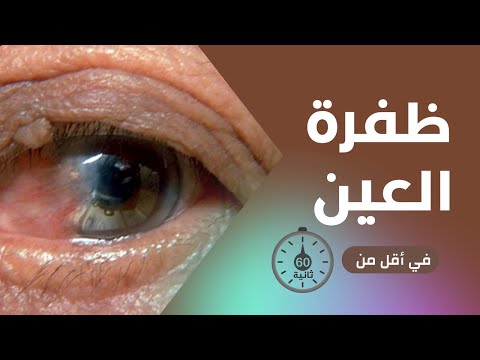 ظفرة العين في أقل من 60 ثانية