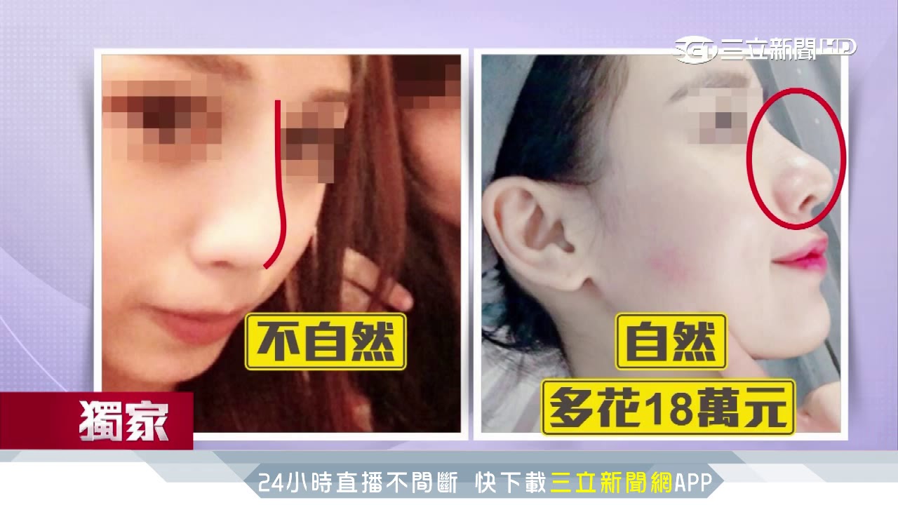 網紅控整鼻卻 歪掉 診所拿美照當宣傳 三立新聞台 Youtube
