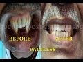 Painless implant placement  senthil dental care