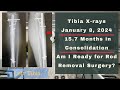 Height Journey - Tibia X-rays 15.7 Months In Consolidation - January 8, 2024