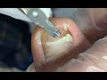 Deep nail cleaning