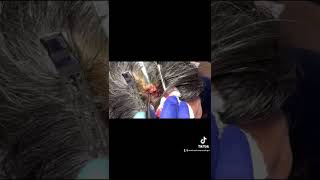 Excision of scalp cyst (Pilar)