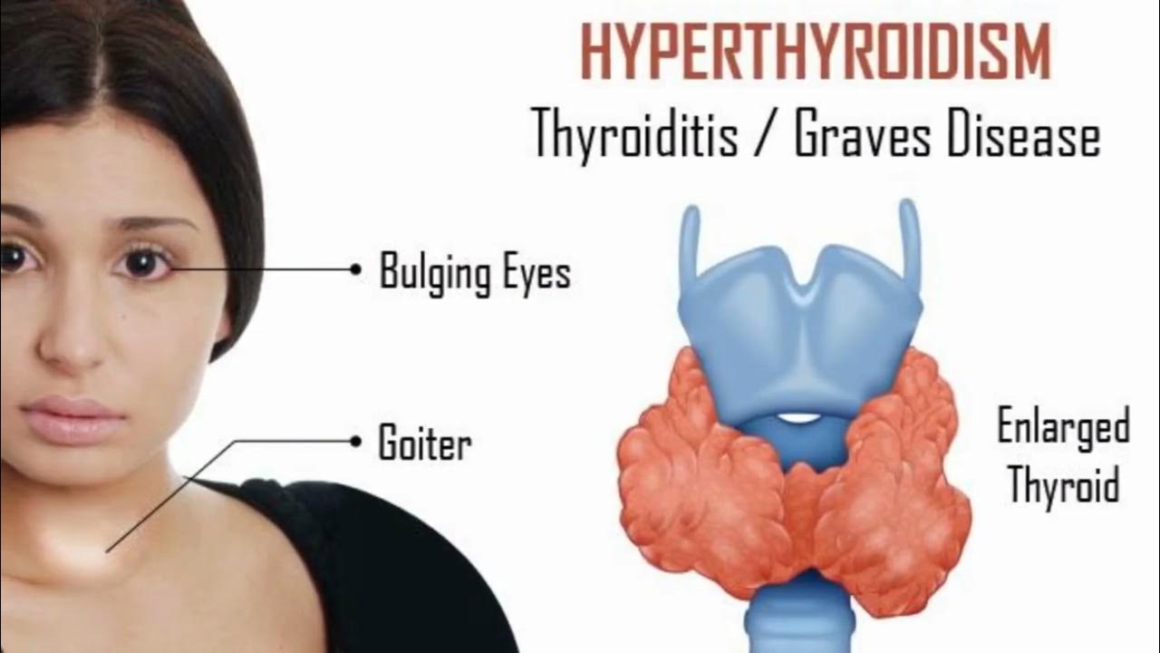 Гиперплазия щитовидной железы что это такое. Гипертиреоз щитовидки. Гипертиреоз, зоб щитовидной железы. Диффузный токсический зоб щитовидной железы.