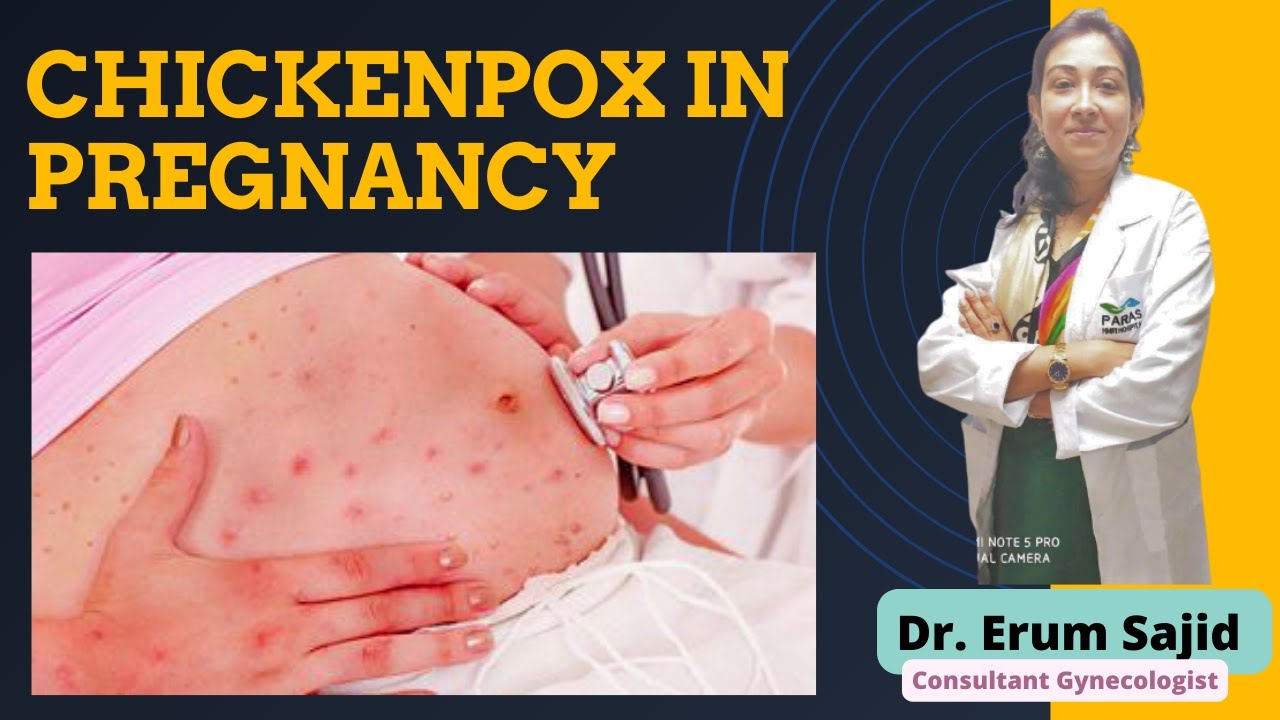 Chickenpox in Pregnancy | Dr Erum Hassan, Best Gynaecologist Patna, Bihar, India 