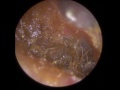 Ear Wax Stuck on Eardrum Removed - Mr Neel Raithatha (The Hear Clinic​)