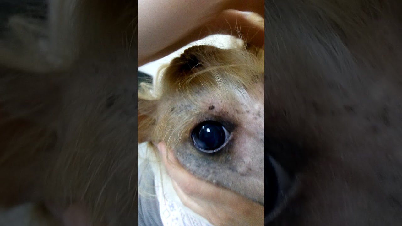 Люксация хрусталика в переднюю камеру глаза - YouTube