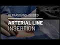 Ultrasound-Guided Arterial Line Insertion // Out-of-Plane Bevel-Guided Technique