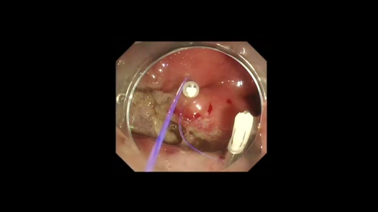 Multiple clip-and-line technique for the complete closure of extensive gastric mucosal defects