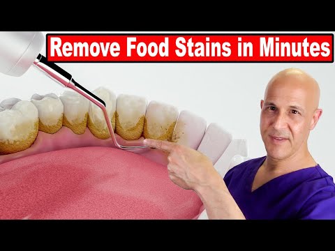 Quickly Remove Food Stains From Teeth | Dr. Mandell