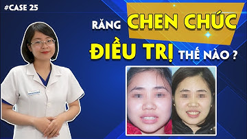 #Case 25: Sự Thay Đổi Kì Diệu Sau Quá Trình Niềng Răng Chen Chúc
