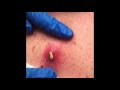 Satisfying cyst pop- it just keeps coming!!