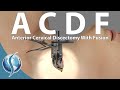 Anterior Cervical Discectomy and Fusion