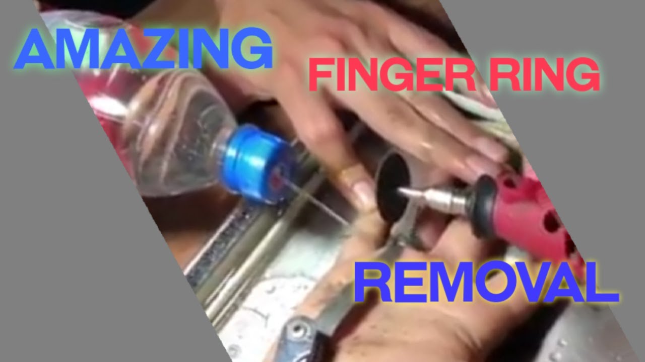 Amazing Finger Ring Removal YouTube