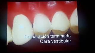 Carilla Premolar