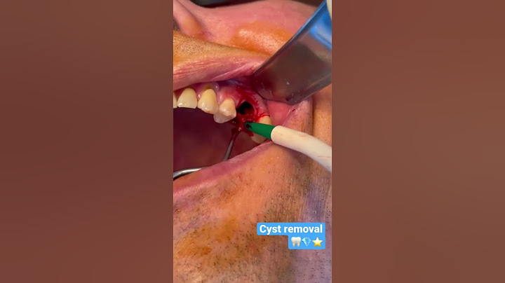 Cyst removal | Oral surgery | Painless dentistry #shorts #health #beauty
