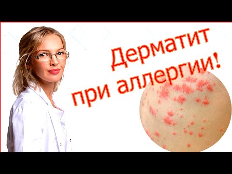 Как Распознать и Вылечить Аллергический Дерматит