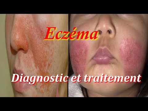 Vidéo: Eczéma Sur Le Visage - Types, étapes Et Traitement