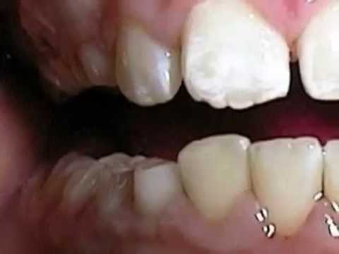 וִידֵאוֹ: פסיכוסומטיקה של מחלות שיניים וחניכיים, מנקודת מבט של פסיכואנליזה