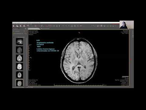 RM cerebral pós-COVID-19. Discussão de dois casos