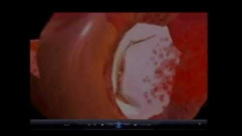 Edwards Life Sciences Animation