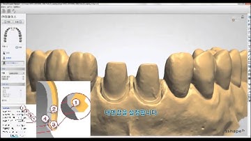 4-3shape dental system(Simple coping Bridge)