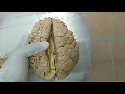 Corpus callosum