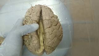 Corpus callosum