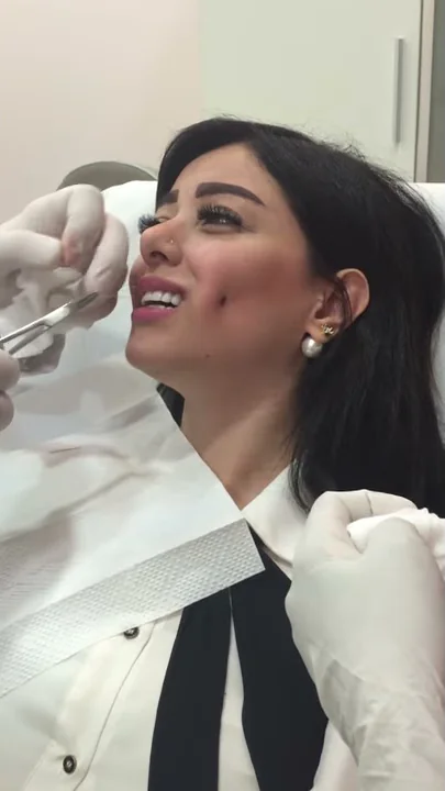 Get Your Dimples Done For A Beautiful Smile Part 2 احصلى على غمازات جذابة في مركز بيلاروما Get Your Dimples Done For A Beautiful Smile Part 2 احصلى على غمازات جذابة في مركز بيلاروما