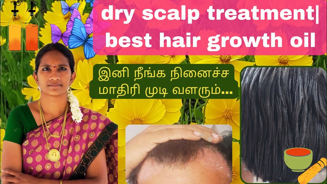Dry Scalp Treatment Best Hair Growth Oil Dry Scalp Treatment In Tamil Dry Scalp Treatment Best Hair Growth Oil Dry Scalp Treatment In Tamil
