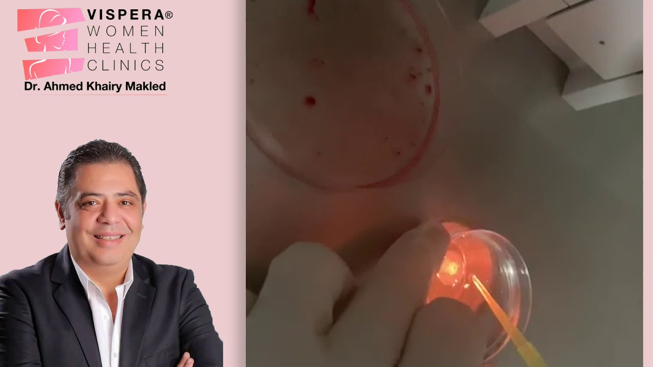 ICSI Operation Explained (شرح لعملية الحقن المجهري لأول مرة)