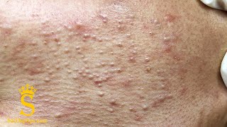 Pimples Around The Neck and Cheeks | Mụn Nổi Quanh Cổ Và Má - SacDepSpa#127