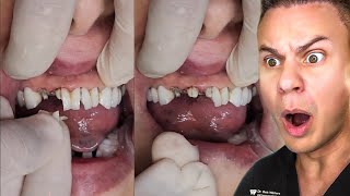 Before Getting Veneers, You Need To Know This!