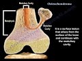 Osteochondroma , solitary and multiple .  Everything You Need To Know - Dr. Nabil Ebraheim