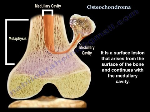 Osteochondroma , solitary and multiple .  Everything You Need To Know - Dr. Nabil Ebraheim