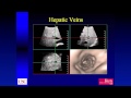 Advanced Techniques in 3D Ultrasound: Fly Thru, Dr. Edward Grant