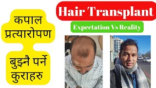 Hair Transplant in Nepal results, before , after , expectations and reality