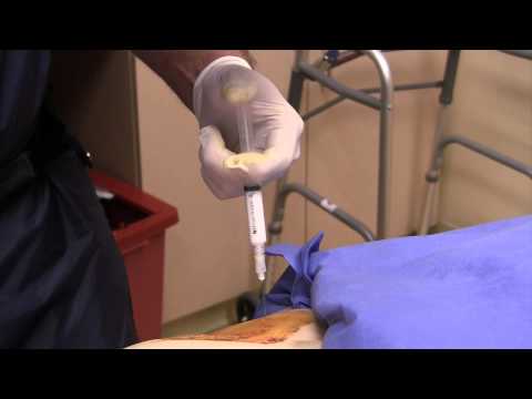 Ultrasound guided corticosteroid injection plantar fasciitis