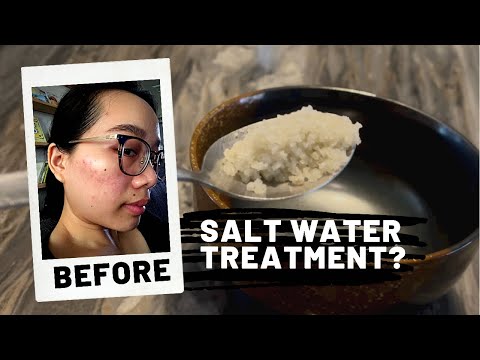 How Salt Water helped my Acne prone skin