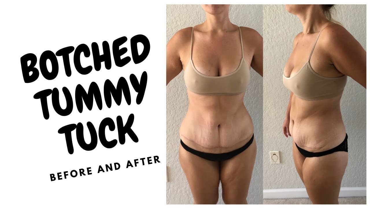 Patient With Botched Tummy Tuck Gets Makeover You Won't Believe