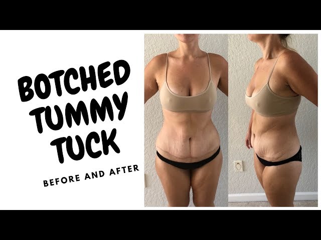 My Tummy Tuck Nightmare - I Was Botched 