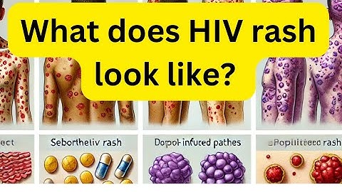 What does HIV rash look like?  HIV Rash Explained: How to Identify Early Signs