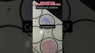 Serological practical WidalTest positive#typhoid fever#trending #practical #pathology#shorts #status