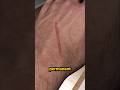 How Do Scars Form And Heal 
