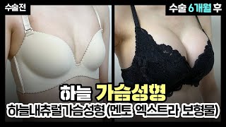 [부산 가슴성형] 이번 여름을 기다렸던 이유? 하늘 내츄럴 가슴성형(멘토 엑스트라 스무스 보형물) 6개월간의 변화과정✨ | 부산성형외과