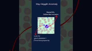 WBC Morphology Part 2: Inherited Anomalies! #bloodsmear #clinicalchemistry #hematology