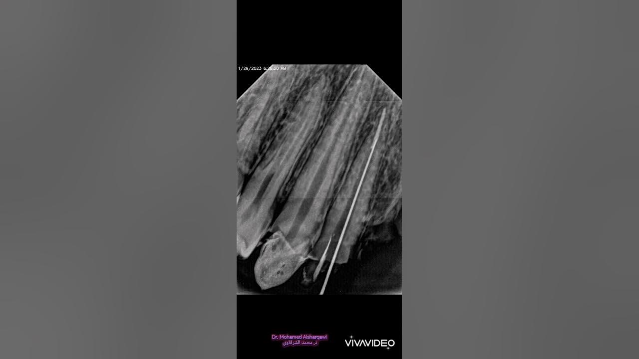 Endodontic treatment reduction for PFM Bridge YouTube