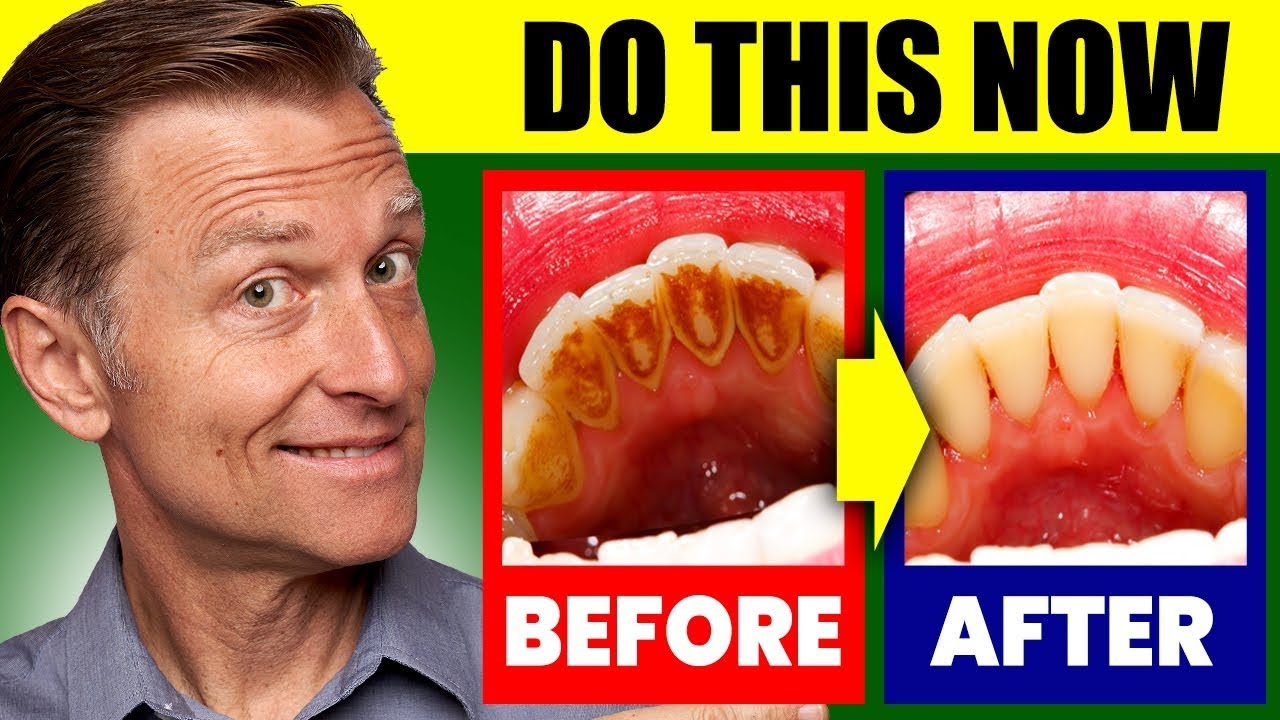 The #1 Top Remedy for Dental Plaque, Cavities, and Gingivitis