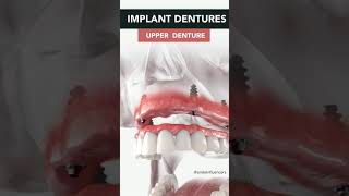 Dentures With Implants .